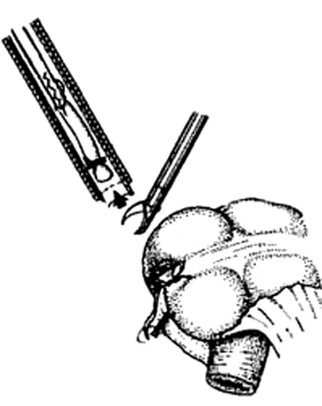 Laparoskopická apendektomie – snesení a odstranění červu, pahýl volně v břišní dutině 
Fig. 6. Laparoscopic appendectomy – dissection and removal of the appendix, a free appendix stump in the abdominal cavity 