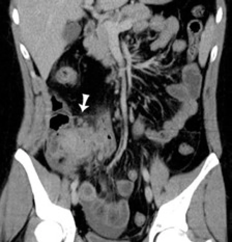 CT koronárny rez: šípka označuje pseudotumor v ileocekálnej oblasti.
Fig. 1. CT of coronary cross-section: arrow indicates pseudotumour in the ileocaecal area.