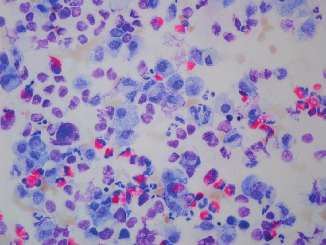 Histologický obraz deskvamativní intersticiální pneumonie, May-Grünwald Giemsa, zvětšení 40x10.
Fig. 3. Desquamative interstitial pneumonia, May-Grünwald Giemsa, magnification 40x10.