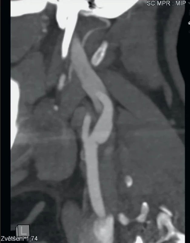 CT angiografie, MIP (maximum intensity projection) rekonstrukce levé vnitřní krkavice prokazující karotický web.