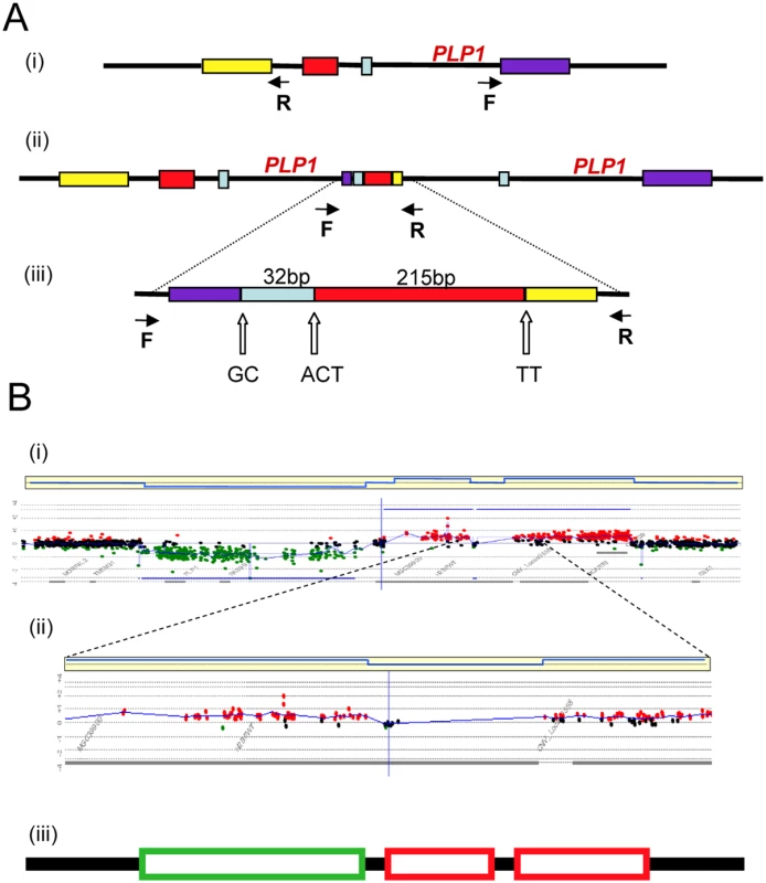 Complex rearrangements involving <i>PLP1</i> detected by junction analysis (A) and oligonucleotide array comparative genomic hybridization analysis (B) <em class="ref">[22]</em>.