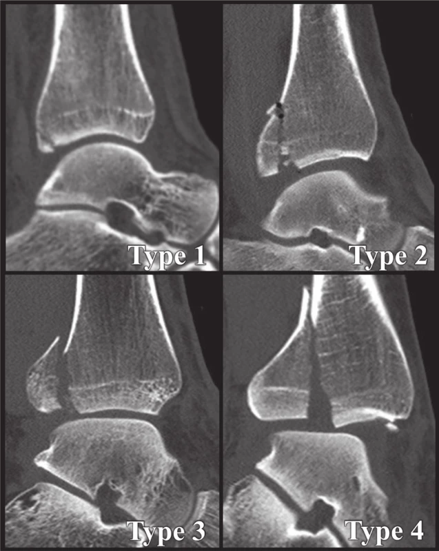 Anatomická 3D CT klasifikace z r. 2015 [34]
Jednotlivé typy z Obr. 6 na CT sagitálních CT řezech.
Fig. 8: Anatomical 3D CT classification published in 2015 [34]
Individual types from Fig. 6 on sagittal CT scans.