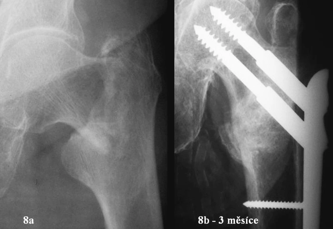 80letá žena. Zlomenina 31A1.2. Úrazový snímek a RTG po zhojení
Fig. 8a-b. 80-year old female. Type 31A1.2 fracture. Posttraumatic and posthealing views