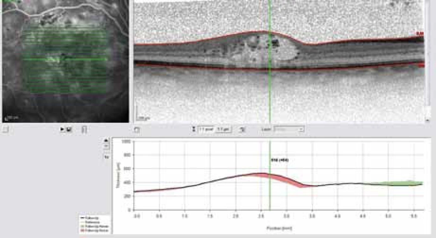 OCT snímek – difuzní diabetický makulární edém před intravitreální injekcí Lucentisu.