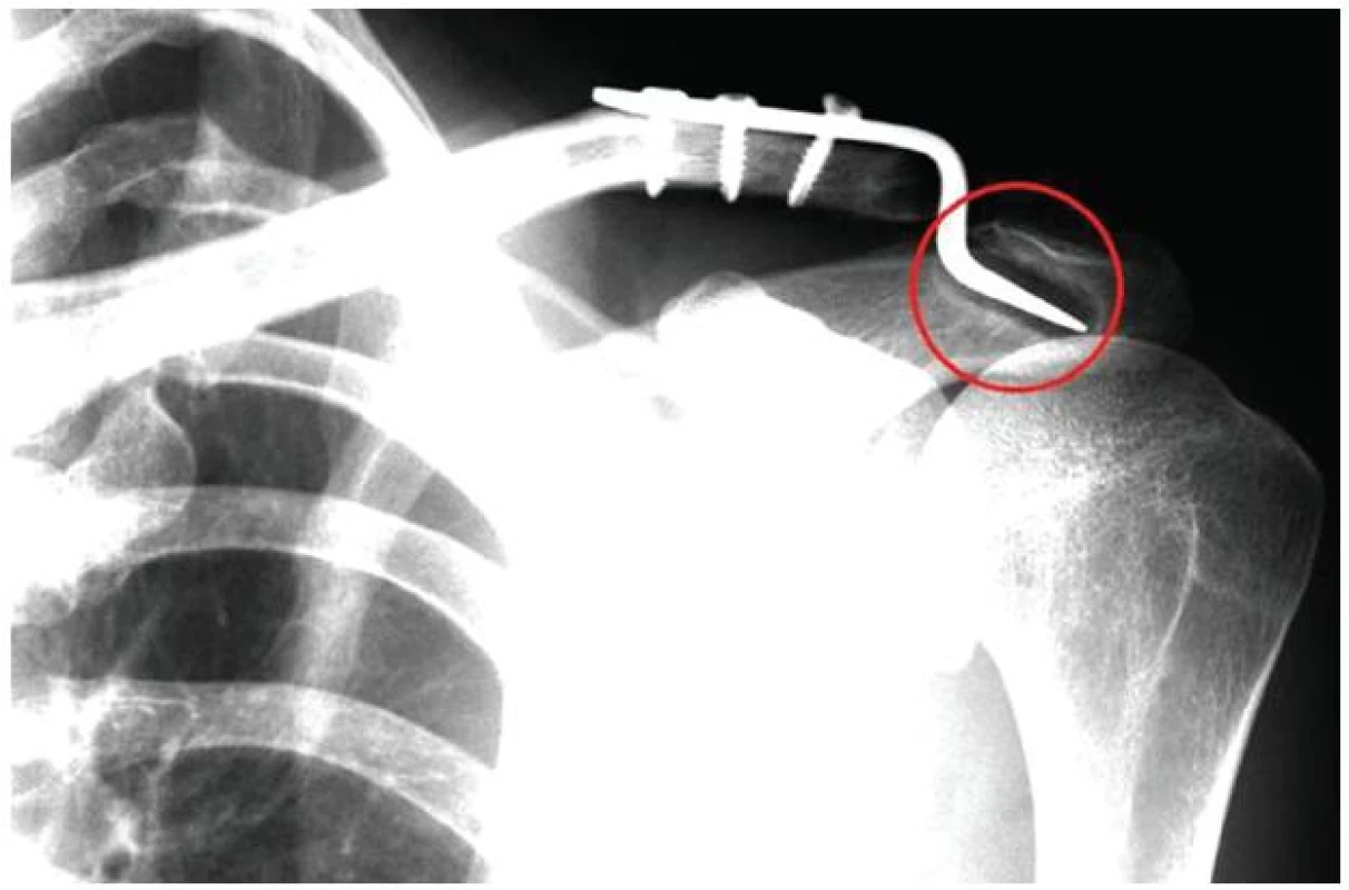 Typický RTG nález iritace akromia
Fig. 3: Typical X-ray finding for acromion irritation