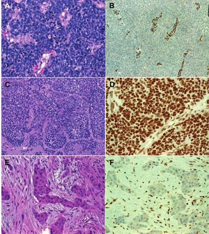 SMARCB1-deficient sinonasal carcinoma with the prototypical basaloid blue cell pattern (A) and complete loss of SMARCB1 (B). In contrast, conventional basaloid SCC (C) showed intact nuclear SMARCB1 (D). Rare examples of SMARCB1-deficient carcinoma with eosinophilic squamoid cell pattern but no keratinization (E), complete loss of SMARCB1 in same case (F).