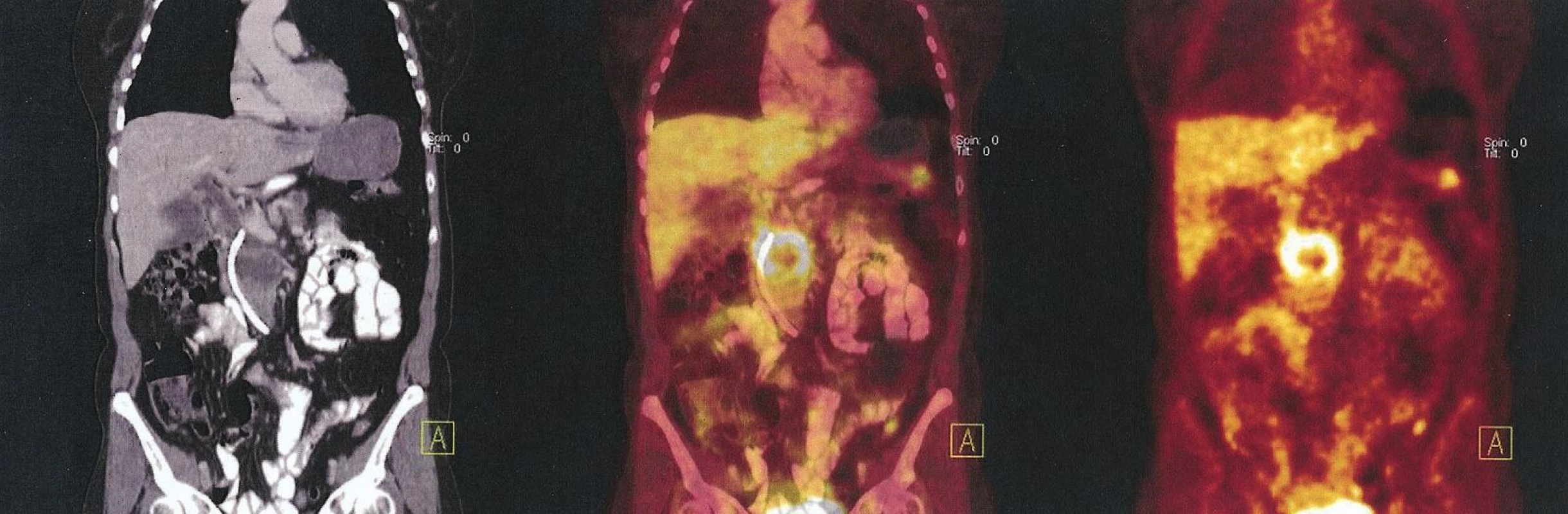 Benigní cystadenom kaudy pankreatu. V CT fázi ložisko v kaudě, bez korelátu v PET fázi
Fig. 3. Benign cystadenoma of the cauda. The CT phasebearing in the cauda without correlate on the PET phase