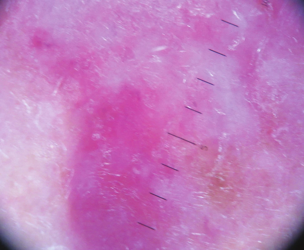 Dermatoskopický nález v polarizovaném světle – obraz duhy, fialovo-červené zbarvení, bílé bezstrukturní okrsky, bělavé šupiny