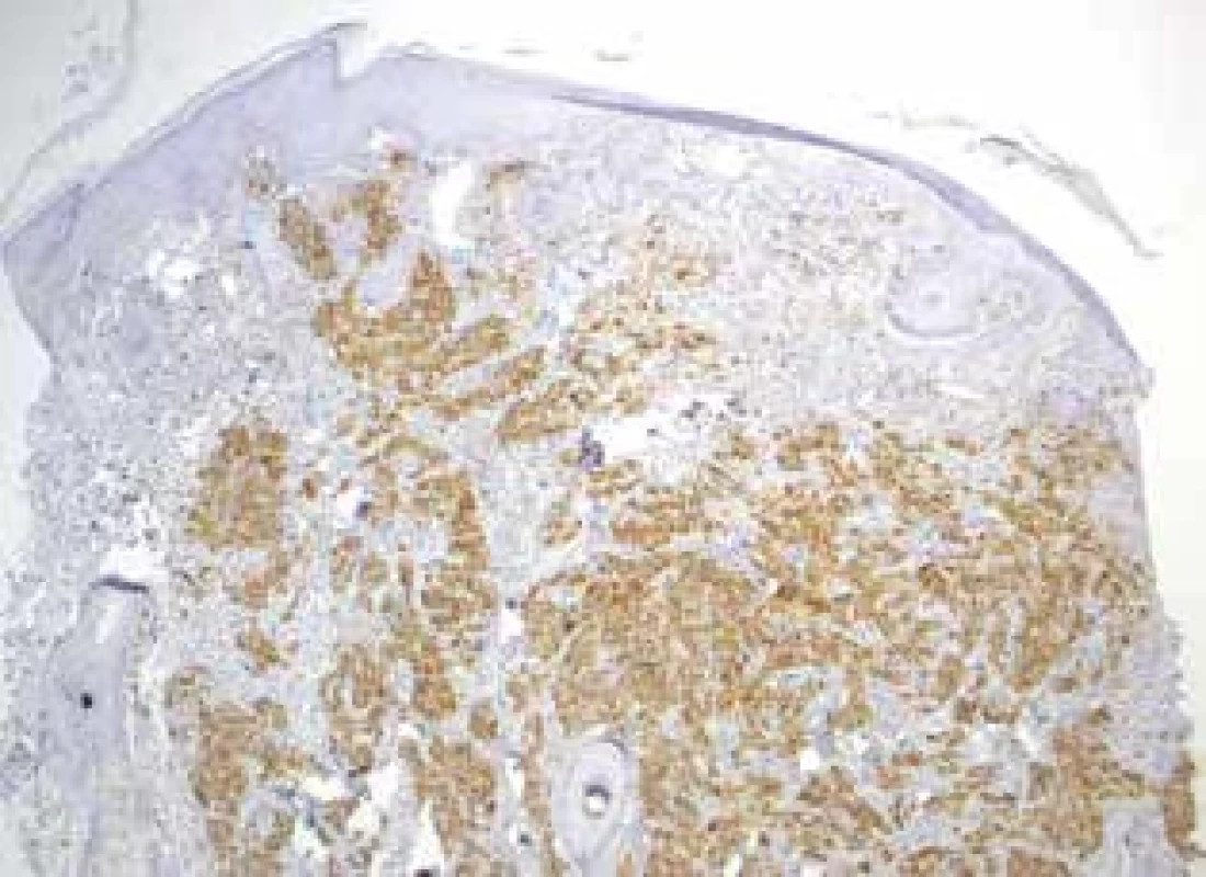 Imunohistochemická cytoplazmatická pozitivita markeru NKI-C3 (CD63)