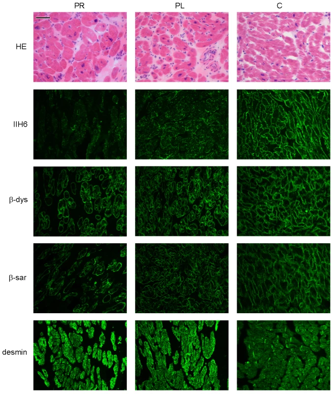 Histology and immunohistochemistry of heart sections of patient II/5 stained with haematoxylin eosin (HE), alpha dystroglycan clone IIH6C4 (IIH6), beta dystroglycan (β-dys), beta-sarcoglycan (β-sar), and desmin.