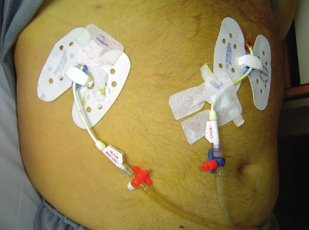 Bilaterálna PTD drenáž oboch lalokov pečene
Fig. 1: Bilateral PTD drainage of both liver lobes