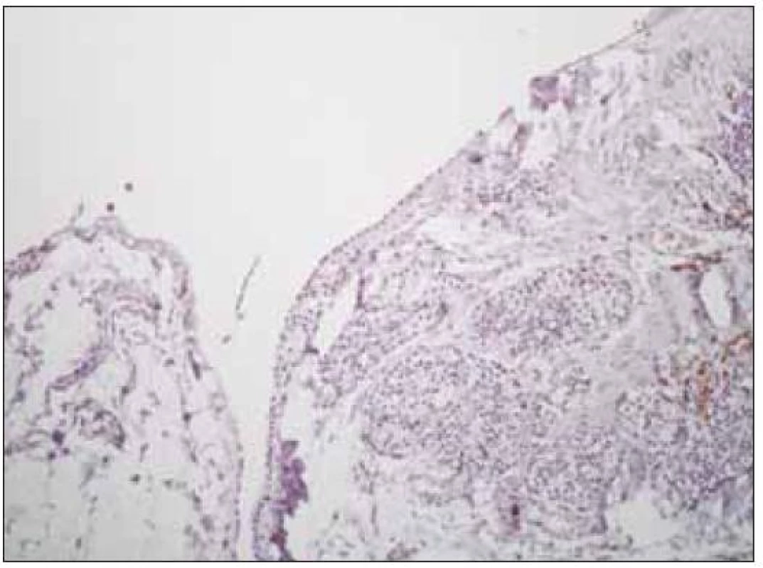 Histologický nález negativní TTF 1, zvětšeno 100x.