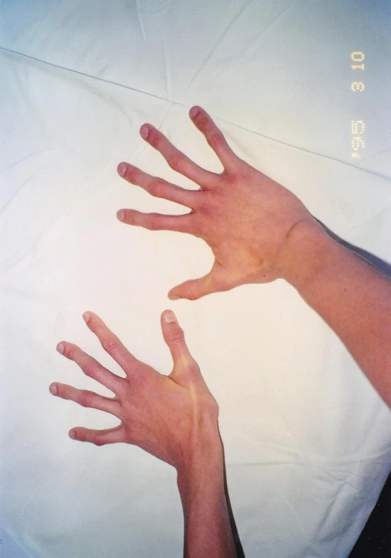 Pavúčie prsty.
Fig. 3. Arachnodactyly (spider-like fingers).