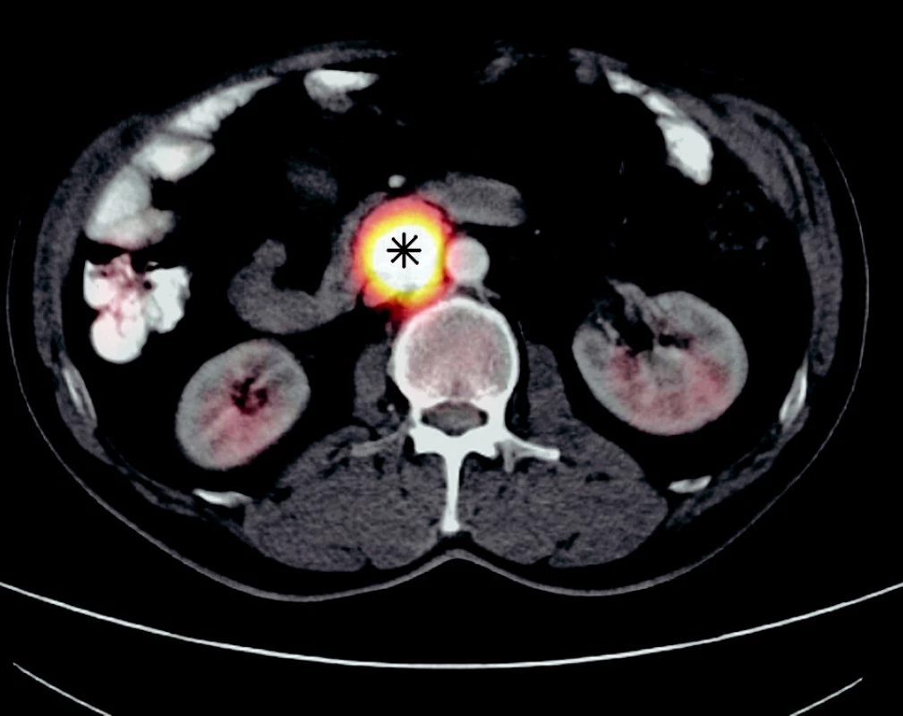  PET/CT diagnostika extraadrenálního paragangliomu, označeno hvězdičkou, snímek zapůjčen z PET centra NNH, Praha
Fig. 1. PET/CT diagnostics of the extraadrenal paraganglioma, highlighted by a star, the view borrowed from the Homolka Hospital (NNH) PET centre, Praha
