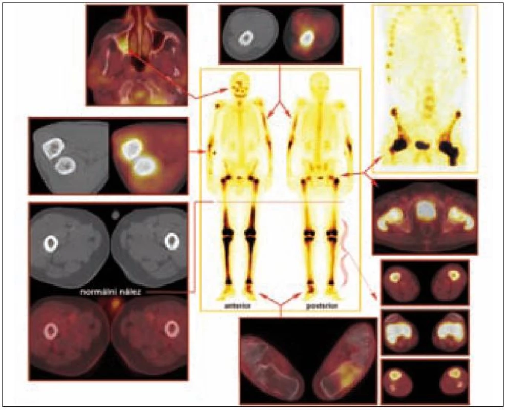 Srovnání nálezů z PET, PET/CT, klasické kostní scintigrafie a SPECT vyšetření u pacienta s Erdheimovou-Chesterovou chorobou.

Celotělová scintigrafie skeletu (uprostřed) a SPECT (vpravo nahoře): Abnormální akumulace radiofarmaka v oblasti hlavy vpravo (zygomatický oblouk, frontální oblast a mandibula), v oblasti horních končetin (střední část levé pažní kosti, proximální části vřetenních kostí oboustranně a v pravém ramenním kloubu) a dále i v oblasti dolních končetin (proximální třetina a distální polovina obou stehenních kostí, obě kosti holenní a kost hlezenní a patní vlevo).

PET a PET/CT: Diskrétní rozšíření a struktura s vyšší denzitou dorzální části laterální stěny dolní poloviny pravého maxilárního sinu, méně nápadný nález také v dorzální části mediální stěny ve stejné etáži. Stejný charakter změn zasahuje kaudálně až do dorzální části alveolárního výběžku maxily vpravo. Výše popsané změny mají pozitivní korelát v PET obraze. Na bázi pravého maxilárního sinu je minimální měkkotkáňový lem.

Výrazně sklerotická struktura skeletu je prostoupena osteolytickými okrsky, v úsecích diafýz je patrné zesílení kompakty, rovněž se zobrazila patologická struktura dřeňové dutiny se zvýšením denzity tkáně v okrajích. Patologická struktura je v oblasti horních končetin (převážná část levého humeru pouze s vynecháním proximální části, v pravém humeru naopak okrsek patologické struktury v oblasti hlavice a v blízkosti loketního kloubu, z větší části je postižena ulna a radius oboustranně s maximem změn v proximálních úsecích) a v oblasti dolních končetin (oba femory s vynecháním úseku asi střední třetiny diafýz, obě tibie, neúplně obě fibuly, vlevo výrazně kost patní, vpravo je v kosti patní jen nevýrazný okrsek při dolním okraji).
