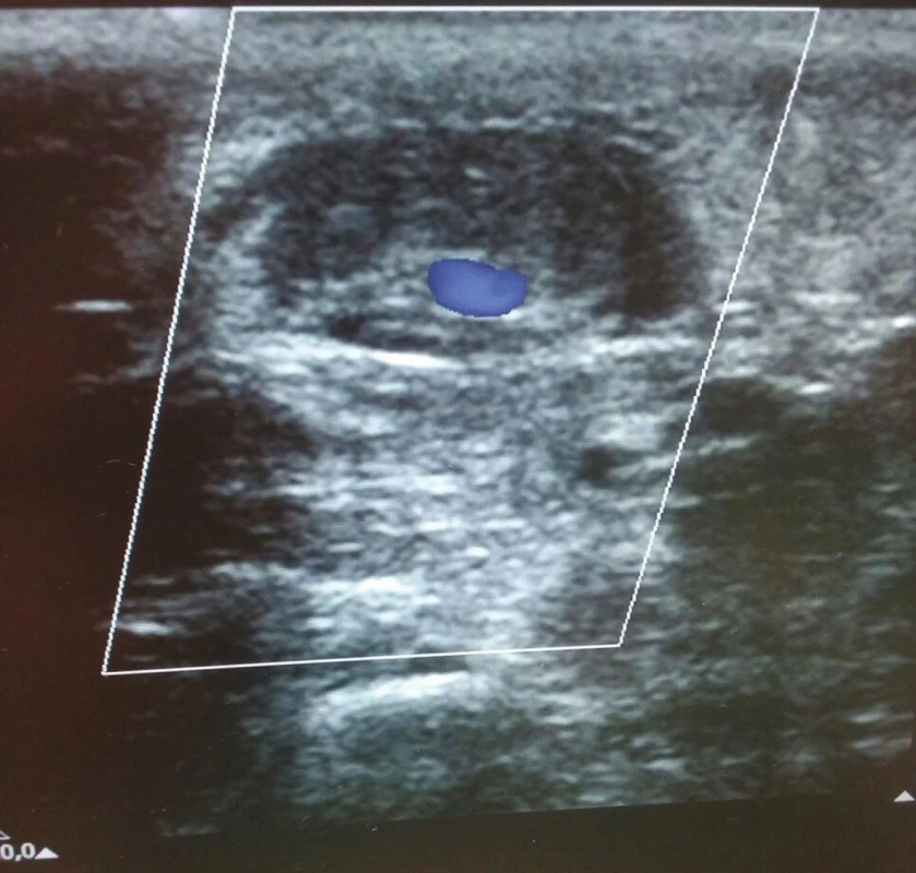 Ultrazvuková kontrola žíly po prvním podvazu s patrným malým reziduálním průtokem
Fig. 5:Ultrasound control of the vein after the first suture shows the presence of mild residual flow