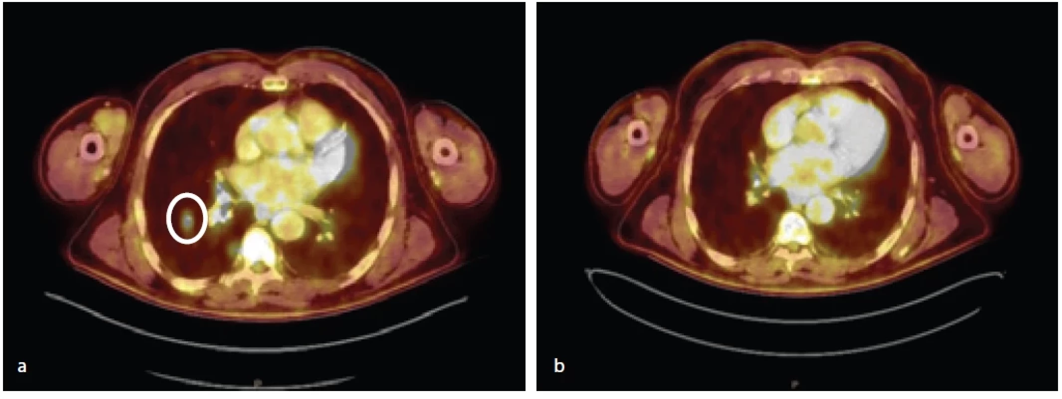 Kompletní regrese plicní metastázy u pacienta č. 12; PET/CT z 7. 8. 2020 (a) a 15. 2. 2021 (b).