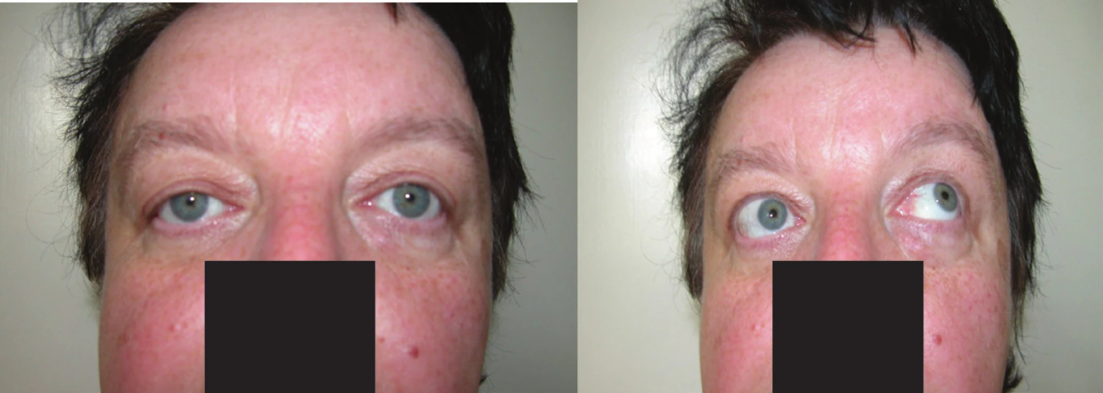 <b>Y-exotropia</b>: minimální levostranná divergence a sursumvergence v primárním postavení bulbů při fixaci pravého oka, při elevaci obou bulbů porucha elevace pravého oka v addukci – 3 st., potvrzuje diagnózu pravostranného Brownova syndromu