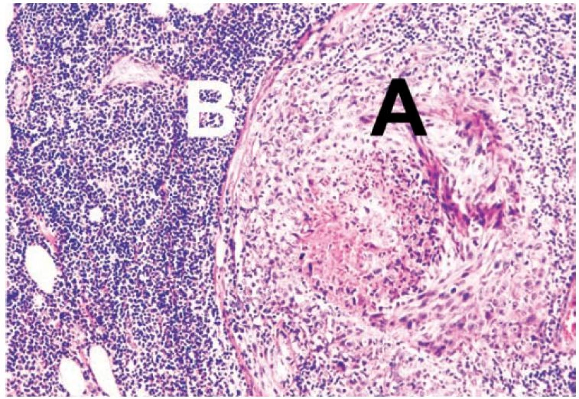 Histologické vyšetření metastázy s masivním lymfocytárním
infiltrátem (a – kožní metastáza, B – lymfocytární infiltrát)
