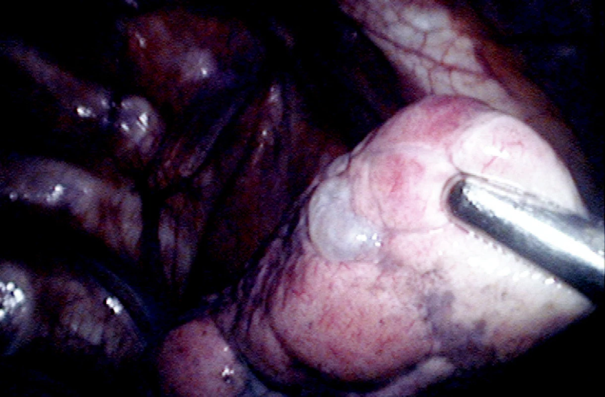 Subpleurální puchýř na apexu pravé plíce (operační foto)
Fig. 2. A subpleural bleb (blister) at the right pulmonary apex (intraoperative photo) 
