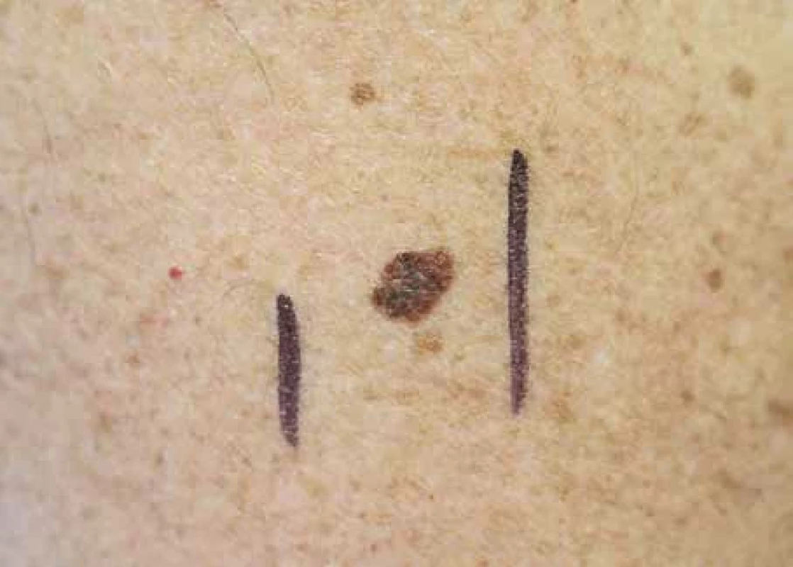 Superficiálně se šířící melanom, Clark II, Breslow 0,2 mm.