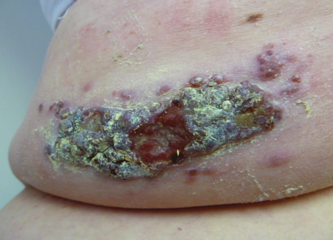 Maligní melanom zad
Fig. 4: Malignant melanoma of the back