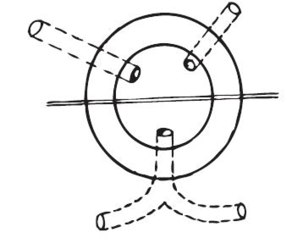 Goodsallovo pravidlo
Fig. 1. Goodsall’s rule