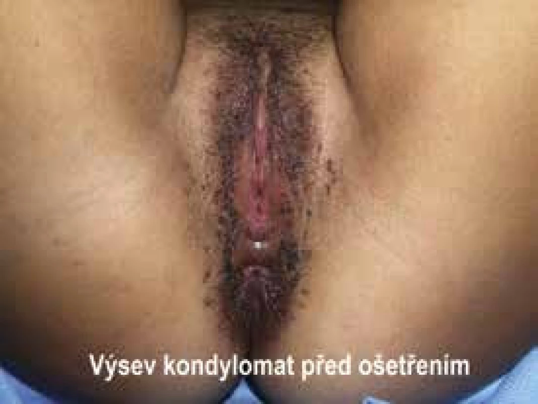 Výsev kondylomat před ošetřením