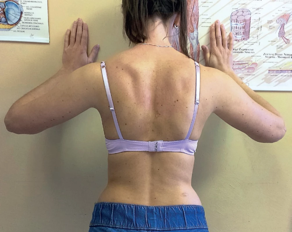 Negatívny test - kľuk o stenu po 5-mesačnej kompletnej rehabilitačnej liečbe.