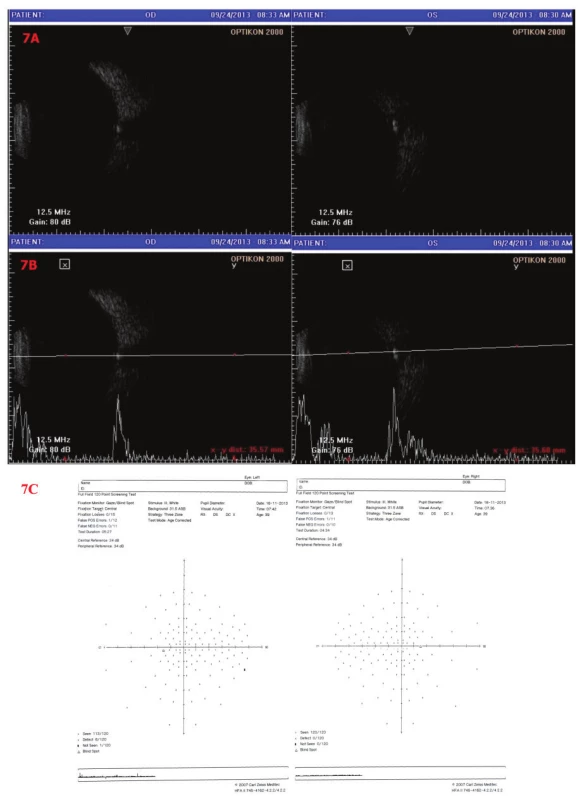 Sonografie a perimetr OPL
7A – B scan, 7B – A i B scan – Oboustranně patrné obrovské drúzy papily ZN. 7C - perimetrické vyšetření – OP fyziologický nález, OL – ojediněle relativní skotomy, jinak fyziologický nález