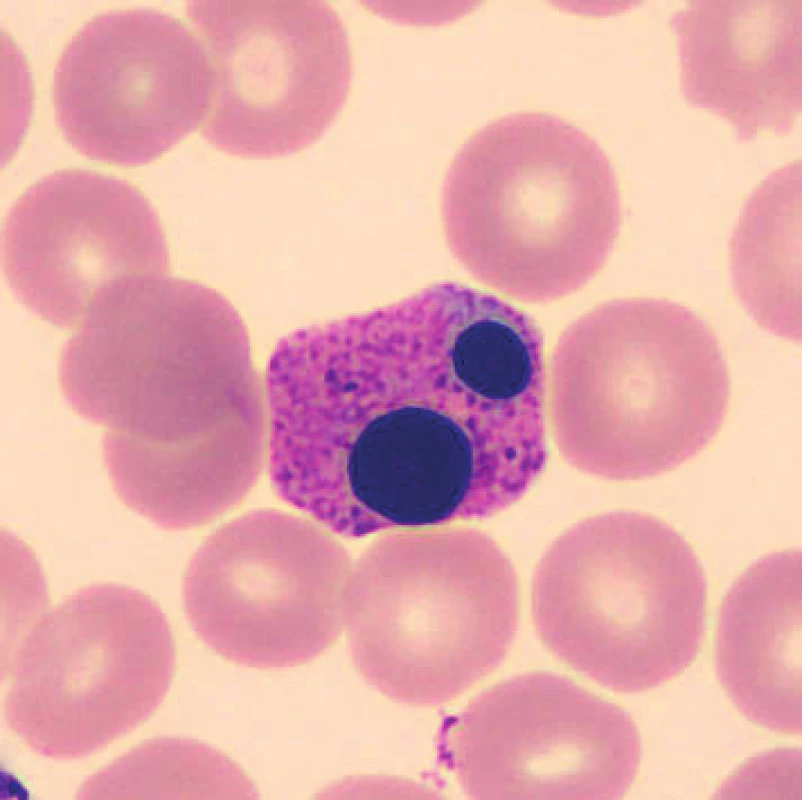 Apoptotická forma neutrofilního segmentu (24 hodin po odběru, laboratorní teplota)