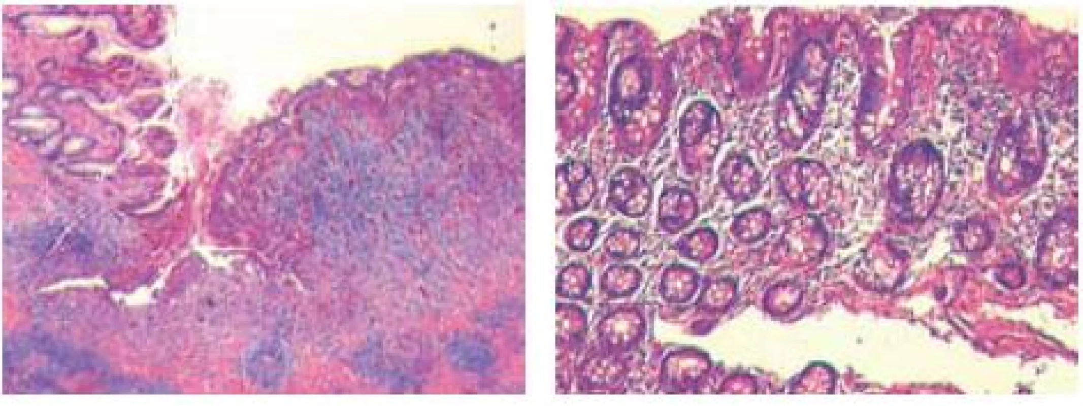Histologický preparát ukazuje vředy s minimální zánětlivou reakcí, granulační tkání a obliterací cév.