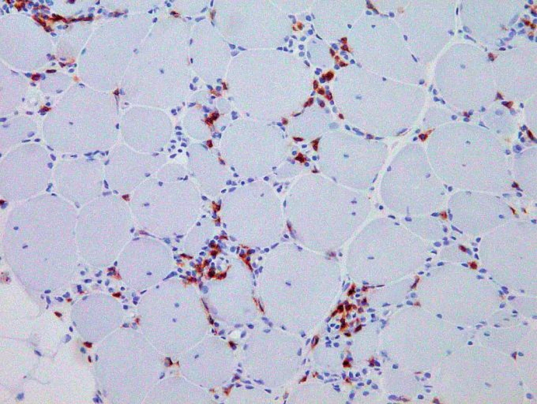 Imunohistochemické vyšetření prokázalo složení intersticiální zánětlivé infiltrace převážně z CD8+ T-lymfocytů. Originální zvětšení 200x.