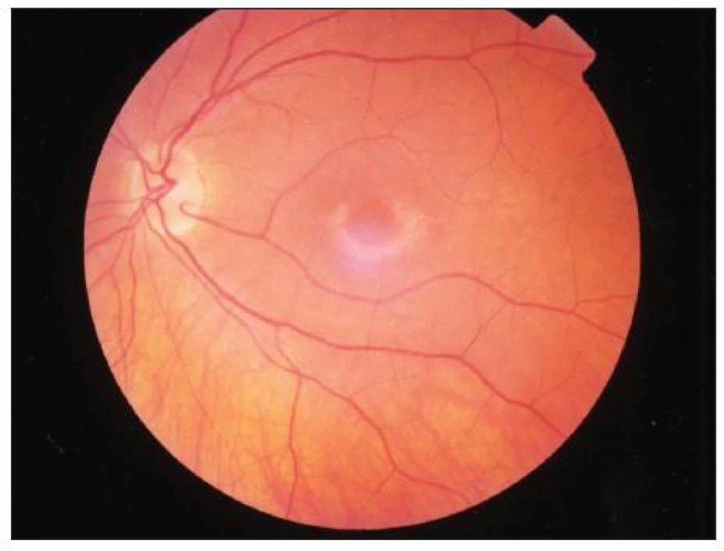 Bull’s eye maculopathy