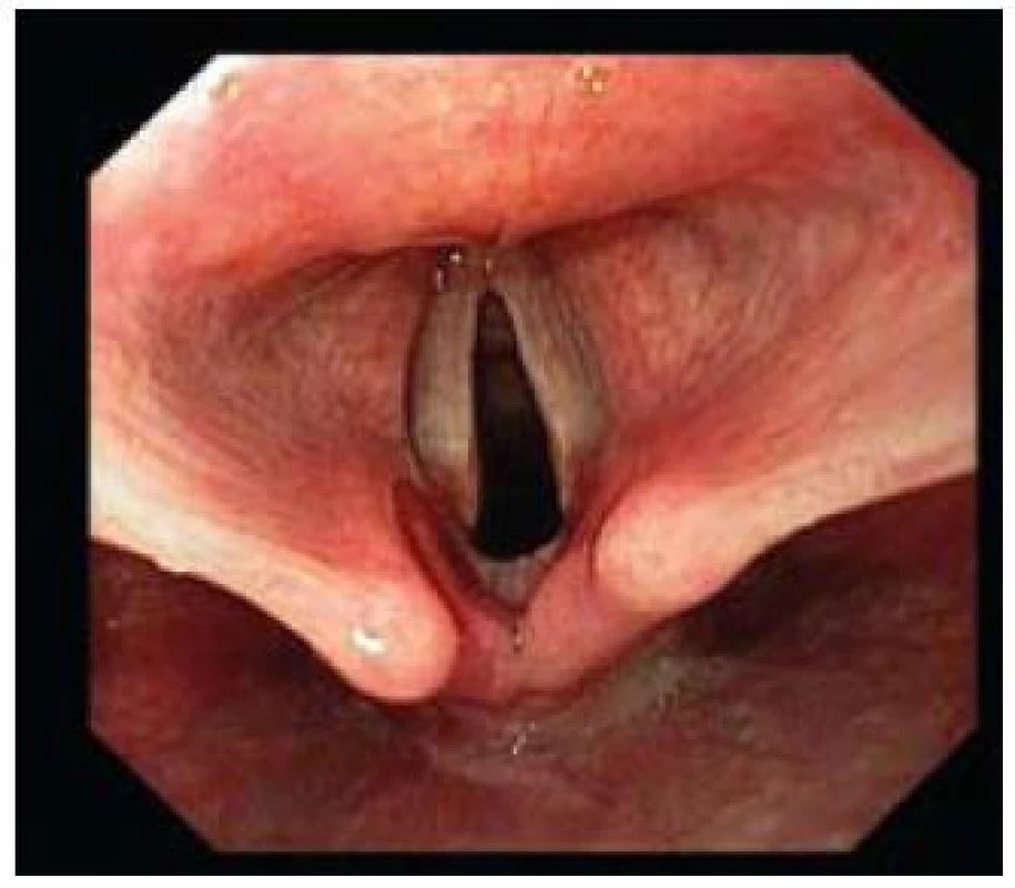 Mírná forma refluxní laryngitidy.
Fig. 11. Mild form of reflux laryngitis.