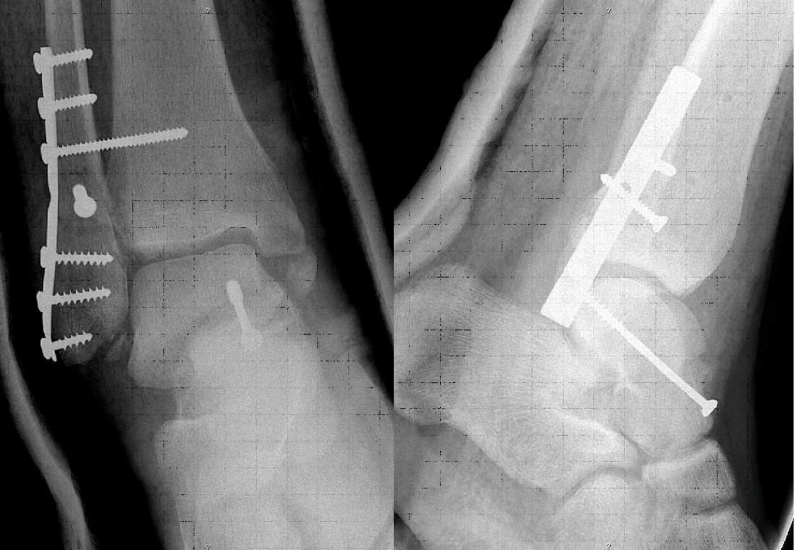 Rtg kontrola po osteosyntéze