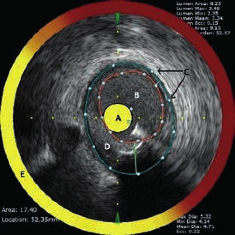 Příčný řez koronární tepnou obsahující LCP zobrazený NIRS-IVUS katétrem (TVC-Imaging System, Infraredx, Burlington, USA).