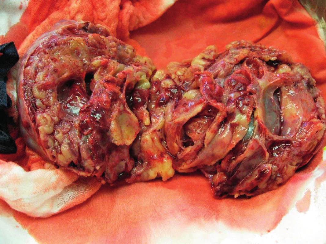 Tumor na řezu