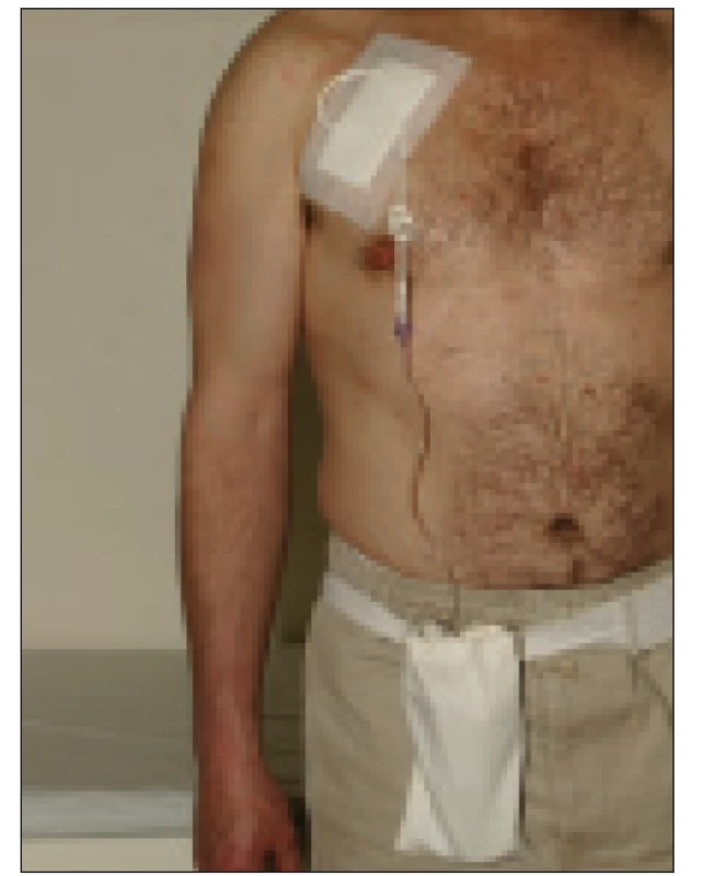 Aplikační systém pro kontinuální intravenózní léčbu treprostinilem.