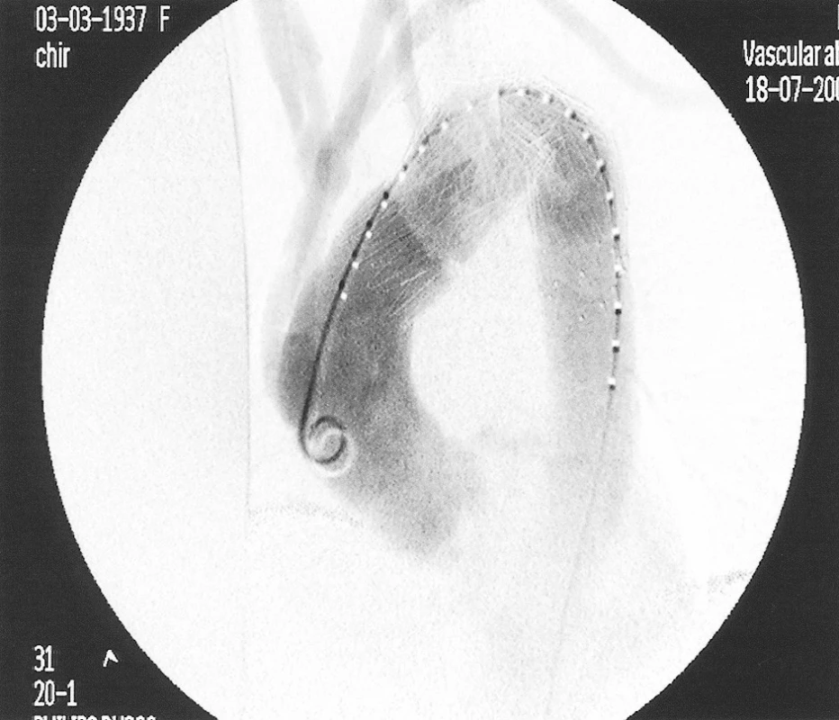 Peroperation angiography after introduction of stent-grafts
Obr. 4. Peroperační angiografie po zavedení stentů