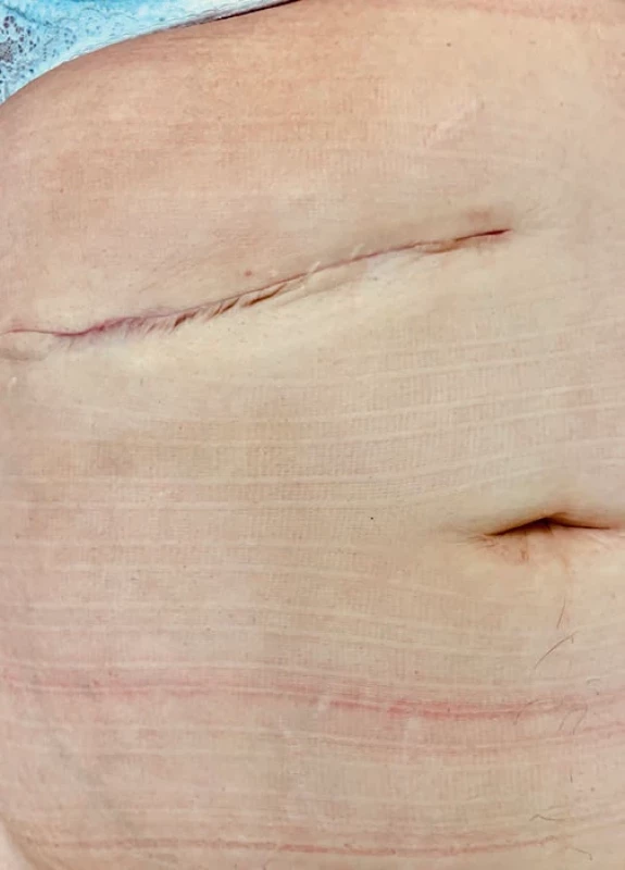 Jizva pravého hypochondria 3 týdny po revizi. Scar of the right hypochondrium 3 weeks after the revision.