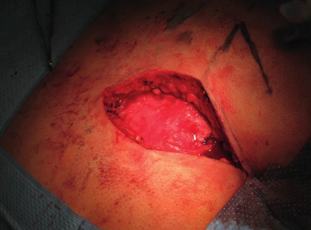 Radikální excize měkkých tkání s píštělí
Fig. 2: Radical excision of soft tissues with fistula