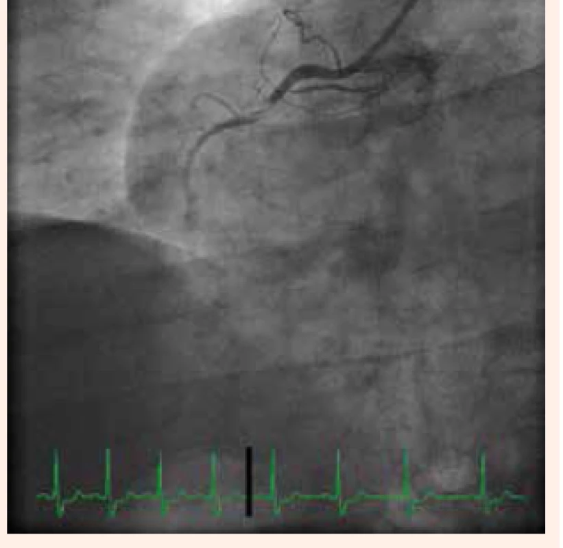 Pacientka s akútnym koronárnym syndrómom bez perzistujúcich elevácií segmentu ST. Trombotické postihnutie PKA pri ruptorovanom aterosklerotickom pláte s hemodynamicky významnou stenotizáciou pravej koronárnej artérie s  prietokom TIMI I. Foto archív autorky