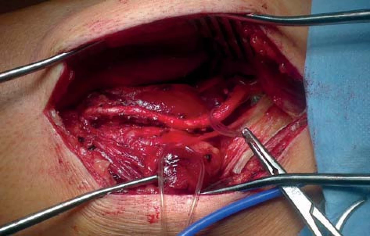 RDACFL mezi hlavami m. quadriceps fem
Fig. 1: DBLCFA passing between quadriceps muscle heads