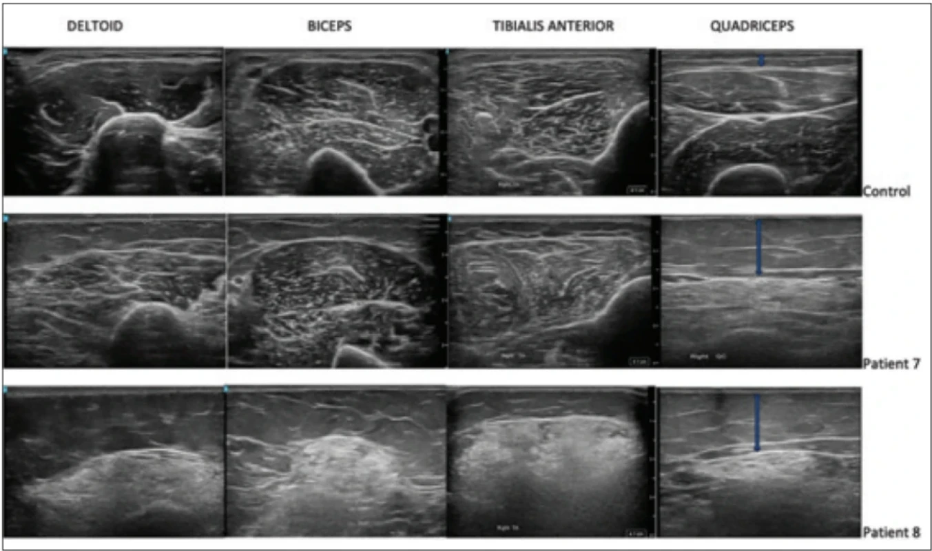 MR svalov 41-ročnej ženy (kontrola) a dvoch pacientiek so spinálnou muskulárnou atrofi ou s rôznym stupňov postihnutia svalov. Prevzaté z [31]. Fig. 3. MRI images of the muscles of a 41-year-old woman (control) and two patients with spinal muscular atrophy with varying degrees of muscle involvement. Adapted from [31].