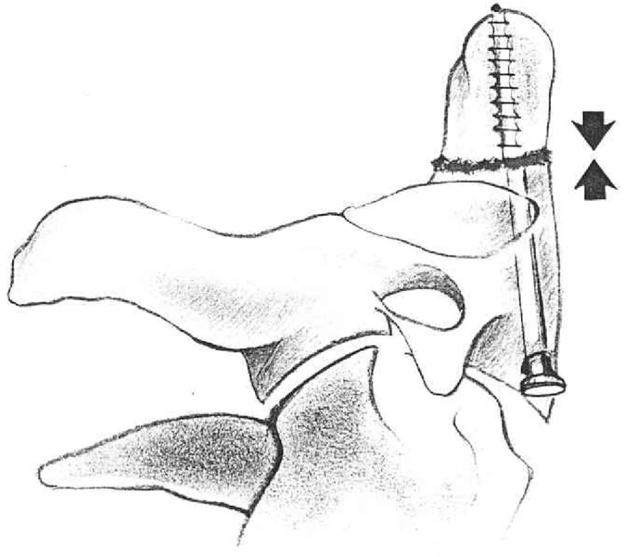Kompresní osteosyntéza šroubem
Fig. 2. Comression osteosynthesis with a screw