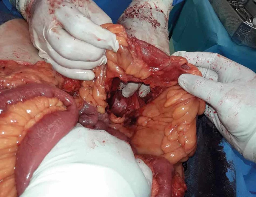 Avulze sigmoidea typu „ucho od košíku“   Fig. 3: Traumatic sigmoid colon avulsion „bucket handle“