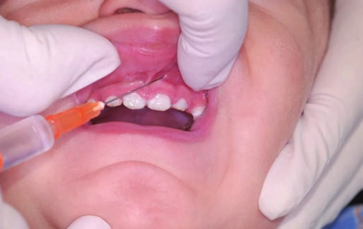 Aplikace lokální anestezie.
Fig. 1. The application of the local anaesthesia.