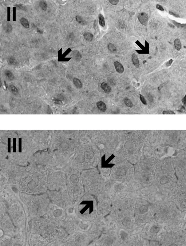 ImunohistologieMDR3 v jaterní tkáni probandek II a III. Šipkami je označeno pozitivní imunobarvení proteinu MDR3, který je přítomen v kanalikulární membráně hepatocytů. Původní zvětšení 400x.
Fig. 1. Immunohistology of MDR3 in liver tissue of the female probands II and III. The arrows indicate positive immunostaining of MDR3 protein which is present in the hepatocyte canalicular membrane. Original magnification 400-fold.