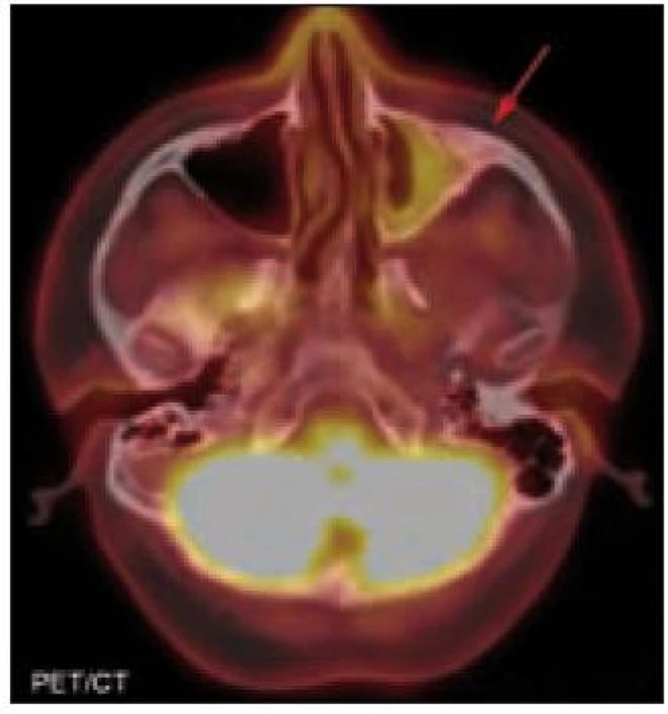PET/CT hlavy. Sklerotizace mediální části levé jařmové kosti. PET komponenta zachycuje difuzně zvýšenou aktivitu radiofarmaka 2-[<sup>18</sup>F]-fluoro-2-deoxy-D-glukózy (<sup>18</sup>F-FDG) v místech strukturálních změn popisovaných na CT.
